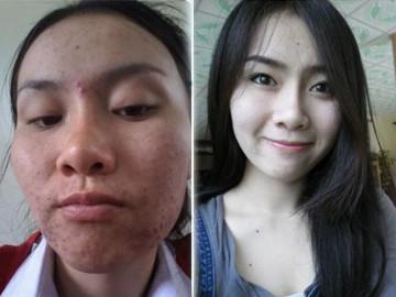 Mụn nhiều như nở hoa hay thâm đen như vừng cơm cháy cũng nhẵn mịn với 3 cách dưới đây