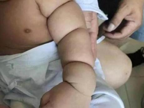 Tay con chia ngấn ai cũng khen dễ thương, mẹ khóc ngất vì bác sĩ bảo "Phải cắt bỏ"