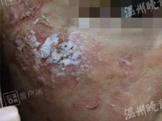 Cô gái trẻ da sần sùi, lở loét sau khi dùng món đồ làm đẹp triệu chị em đều biết