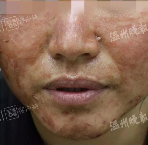 Cô gái trẻ da sần sùi, lở loét sau khi dùng món đồ làm đẹp triệu chị em đều biết - 3