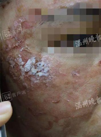 Cô gái trẻ da sần sùi, lở loét sau khi dùng món đồ làm đẹp triệu chị em đều biết - 1