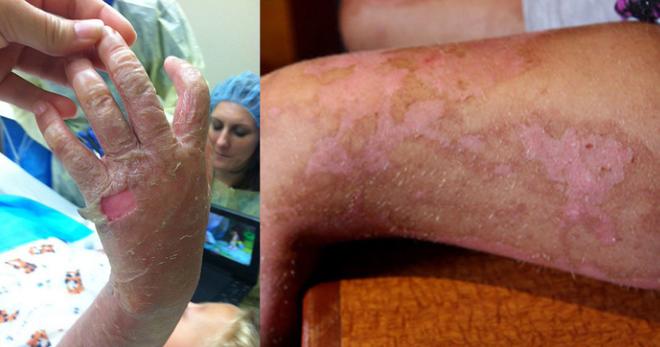 Sốc: 5 bé gái bị bỏng nặng sau khi trêu đùa thứ mọi gia đình đều có trong bếp - 2