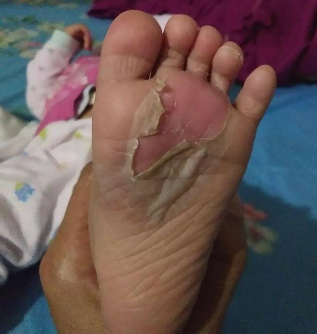 Mẹ vội vã trị ho cho con theo cách dân gian, trẻ nhỏ bị phỏng rộp, tróc da đau đớn - 2