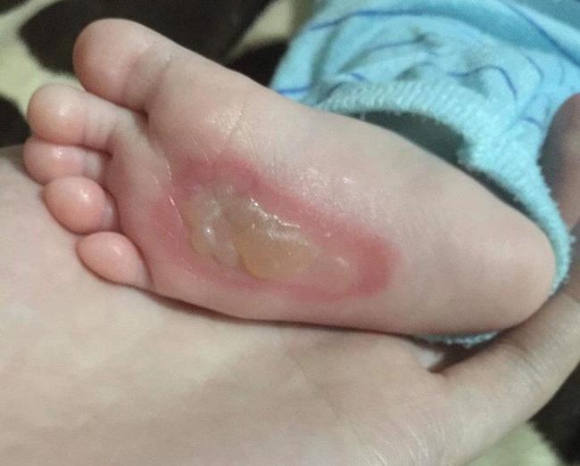 Mẹ vội vã trị ho cho con theo cách dân gian, trẻ nhỏ bị phỏng rộp, tróc da đau đớn - 1