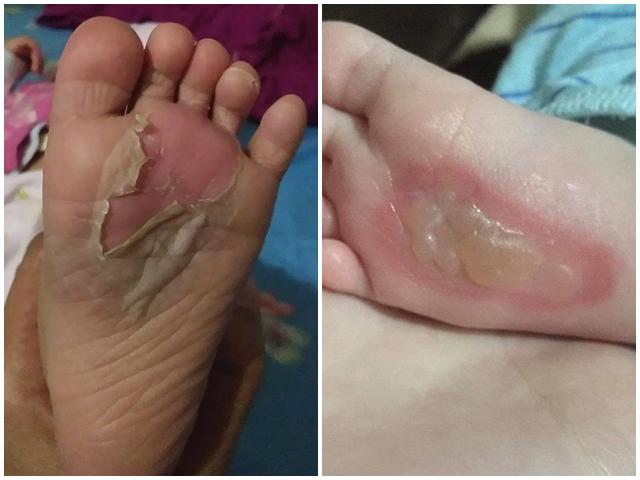 Mẹ vội vã trị ho cho con theo cách dân gian, trẻ nhỏ bị phỏng rộp, tróc da đau đớn