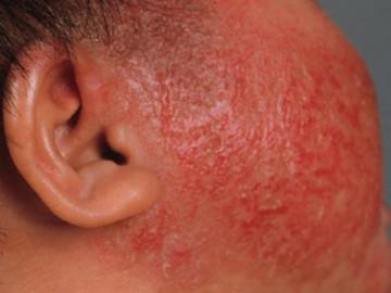 Bấn loạn khi da con đỏ như tôm luộc vì viêm da cơ địa, làm gì để con hết ngứa?