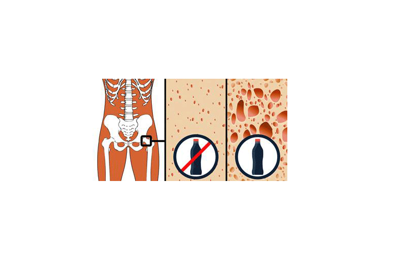 Ngoài béo phì và tổn thương đến gan, một lý do khác cho thấy bạn nên bỏ thói quen uống soda là ảnh hưởng của nó đối với xương.
