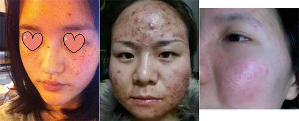 Hãi hùng với làn da lở loét vì sử dụng mặt nạ giấy, tất cả cũng chỉ tại ham rẻ - 4