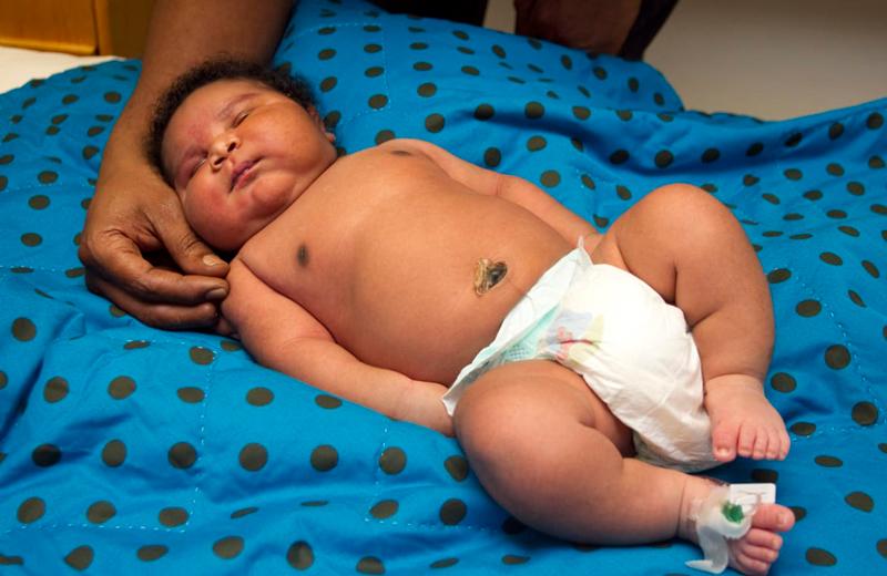 Năm 2011, sản phụ Janet Johnson đã hạ sinh một em bé nặng tới 7,2kg và dài 61cm tại bệnh viện Longview ở Texas. Đây là em bé được sinh ra nặng nhất tại bệnh viện này.
