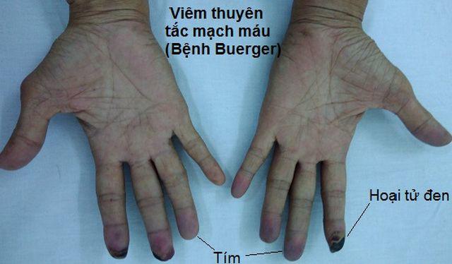 ngon tay dot nhien chuyen mau den si, chi em canh bao chong phai dung thoi quen nay ngay - 3