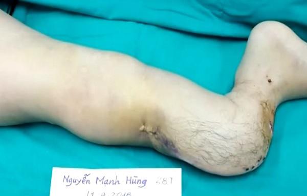 28 năm nuốt nước mắt bị trêu amp;#34;đi giống ếchamp;#34;, chàng trai gặp phép màu sau tai nạn bất ngờ - 2
