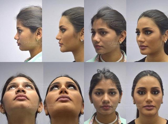 Có bất công cho H’Hen Niê khi Á hậu Hoàn vũ 2018 lộ ảnh “dao kéo” trước khi đăng quang? - 2