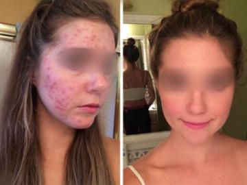 Chạy ra chợ mua rau diếp cá về làm theo cách này, mụn cứng đầu đến đâu cũng hết sạch