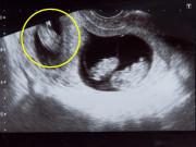 Bà bầu - Mang thai 3, mẹ đau đớn nằm trên giường đẻ chỉ nghe được một tiếng khóc