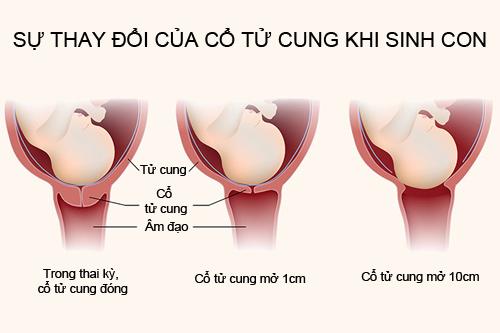 Quá trình cổ tử cung mở từ 1cm-10cm khi đẻ thường diễn ra như thế nào? - 3