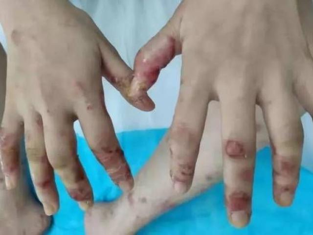 Cô gái bị mụn rộp ở tay chân sau khi ăn cá mỗi ngày, bác sĩ lý giải nguyên nhân