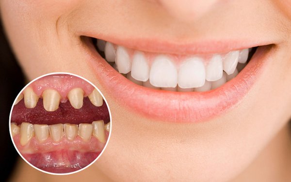 Những điều bạn nhất định phải biết trước khi tiến hành bọc răng sứ