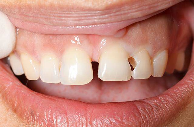 Những điều bạn nhất định phải biết trước khi tiến hành bọc răng sứ