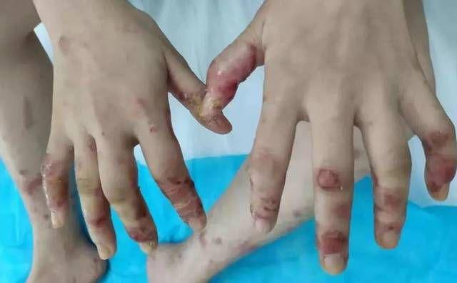 Cô gái bị mụn rộp ở tay chân sau khi ăn cá mỗi ngày, bác sĩ lý giải nguyên nhân - 2