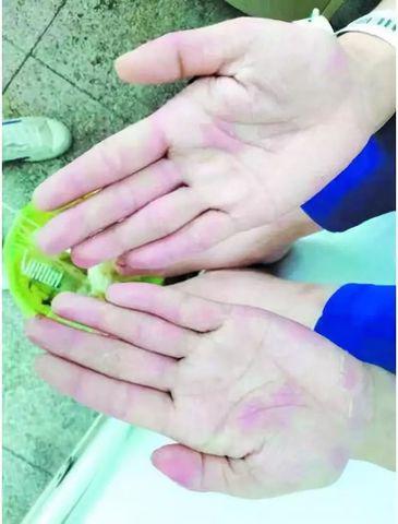 Cô gái bị mụn rộp ở tay chân sau khi ăn cá mỗi ngày, bác sĩ lý giải nguyên nhân - 3