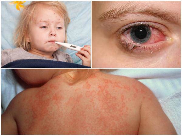 Sốt siêu vi ở trẻ em: Những biến chứng nguy hiểm có thể xảy ra - 3