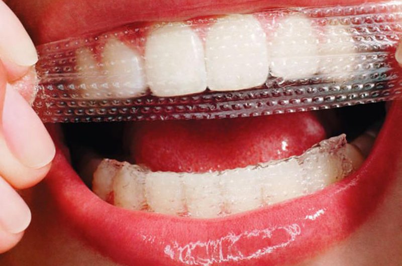 Trên thị trường quảng cáo rất nhiều sản phẩm, công thức làm trắng răng nhanh chóng như miếng dán trắng răng. Thực tế, miếng dán làm trắng có xu hướng làm suy yếu lớp men bảo vệ của răng khiến răng trở nên yếu hơn. 
