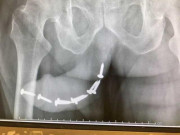 Sức khỏe - Thanh niên nhập viện vì cấy chục đinh vít vào "cậu nhỏ" để tăng khoái cảm khi “yêu”