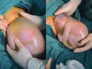 Tin tức - Hy hữu: Bé trai sinh non còn nguyên trong túi ối, nhăn nhó không muốn ra ngoài