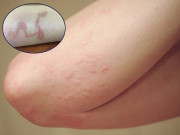Tin tức - Ba mẹ con bị ngứa râm ran khắp người, đi khám phát hiện cùng mắc chung một loại bệnh