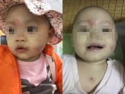Tin tức - Đi học buổi đầu tiên, bố phát hiện con 14 tháng tuổi bầm tím mặt, tinh thần hoảng loạn