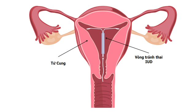 Thai ngoài tử cung: Triệu chứng, nguyên nhân và cách xử lý an toàn nhất - 2