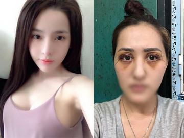 Chi 48 triệu cắt mí ở spa của hotgirl dao kéo, cô gái nhận về cái kết đắng lòng