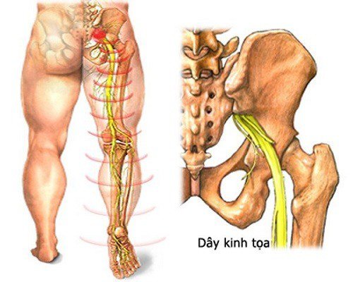Nguyên nhân và cách điều trị đau thần kinh tọa - 1