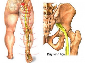 Nguyên nhân và cách điều trị đau thần kinh tọa