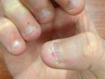 Bé gái 13 tuổi cắn ngón tay đến chảy máu vì ký ức đáng sợ về bố mẹ