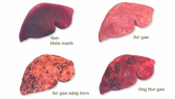 Giám đốc BV K hướng dẫn cách phòng bệnh ung thư có tỷ lệ mắc mới nhiều nhất Việt Nam - 1
