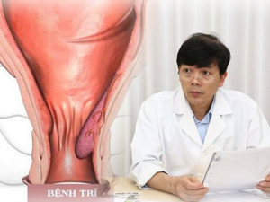 Một nửa dân số mắc phải bệnh trĩ: Chị em sinh đẻ, dân văn phòng đều sợ “khóc thét”