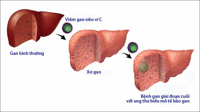 Triệu chứng và cách điều trị viêm gan C - 1