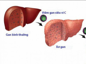 Triệu chứng và cách điều trị viêm gan C