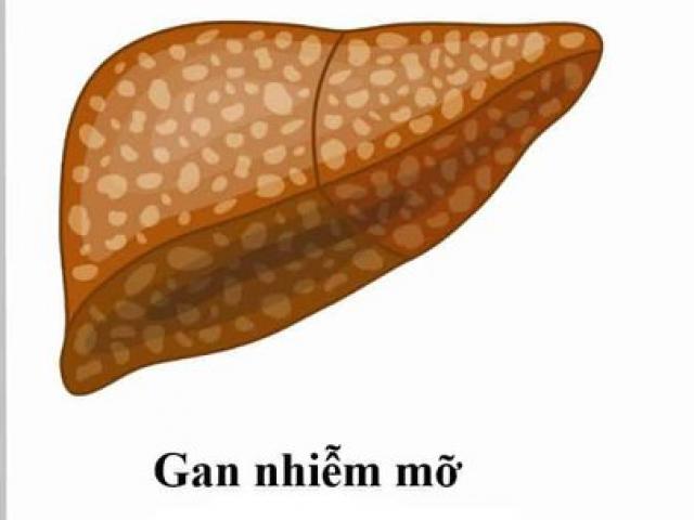Triệu chứng và cách phòng ngừa gan nhiễm mỡ độ 2