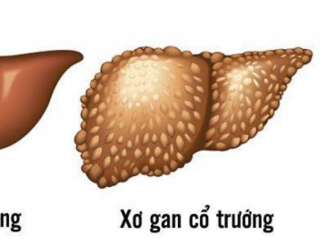 Nguyên nhân và triệu chứng xơ gan cổ trướng