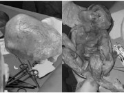 Tin tức - Đau bụng nhiều ngày, người phụ nữ bàng hoàng phát hiện thai nhi hóa đá trong bụng suốt 15 năm