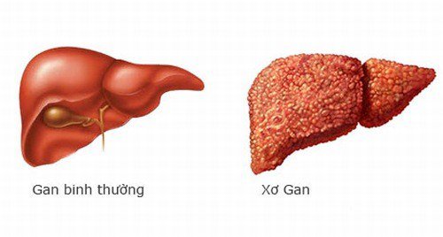 Bệnh xơ gan giai đoạn cuối có chữa được không? - 1