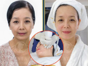 Bí quyết làm đẹp - Bạn biết gì về hai công nghệ nâng cơ trẻ hóa da không xâm lấn đang hot hiện nay?
