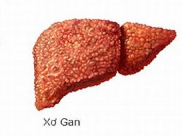 Bệnh xơ gan giai đoạn cuối có chữa được không?