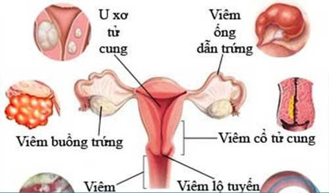 Khí hư nhiều, ngứa vùng kín - dấu hiệu ung thư cổ tử cung chị em thường bỏ qua    - 1