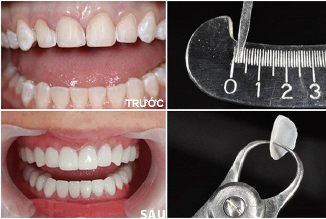 5 quan niệm sai lầm hài hước về bọc răng sứ mà nhiều người mắc phải - 1