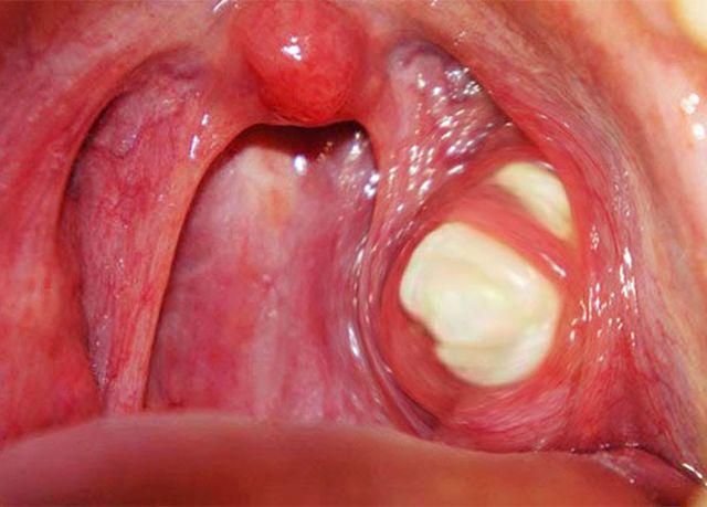 Cô gái bị bạn trai chia tay vì hôi miệng, đi khám bác sĩ phát hiện điều bất ngờ