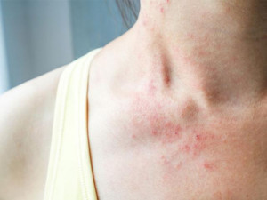 Nguyên nhân và cách điều trị viêm da dị ứng