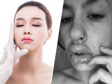 Mê tiêm filler giá rẻ, cô gái 9X suýt bị hoại tử vì đôi môi sưng phồng như ong đốt